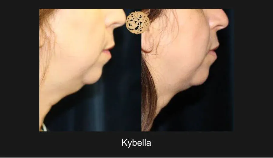 Kybella Before & After