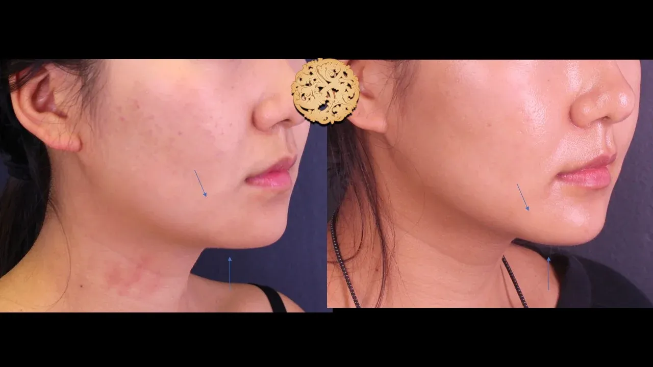 Kybella Before & After