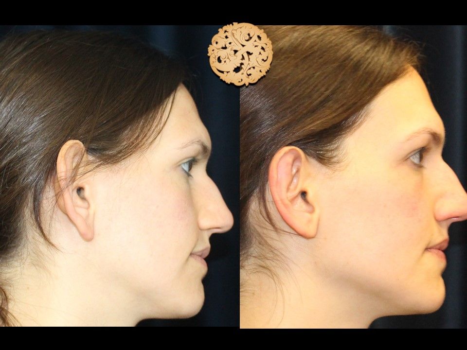 Earlobe Reduction Repair Before & After