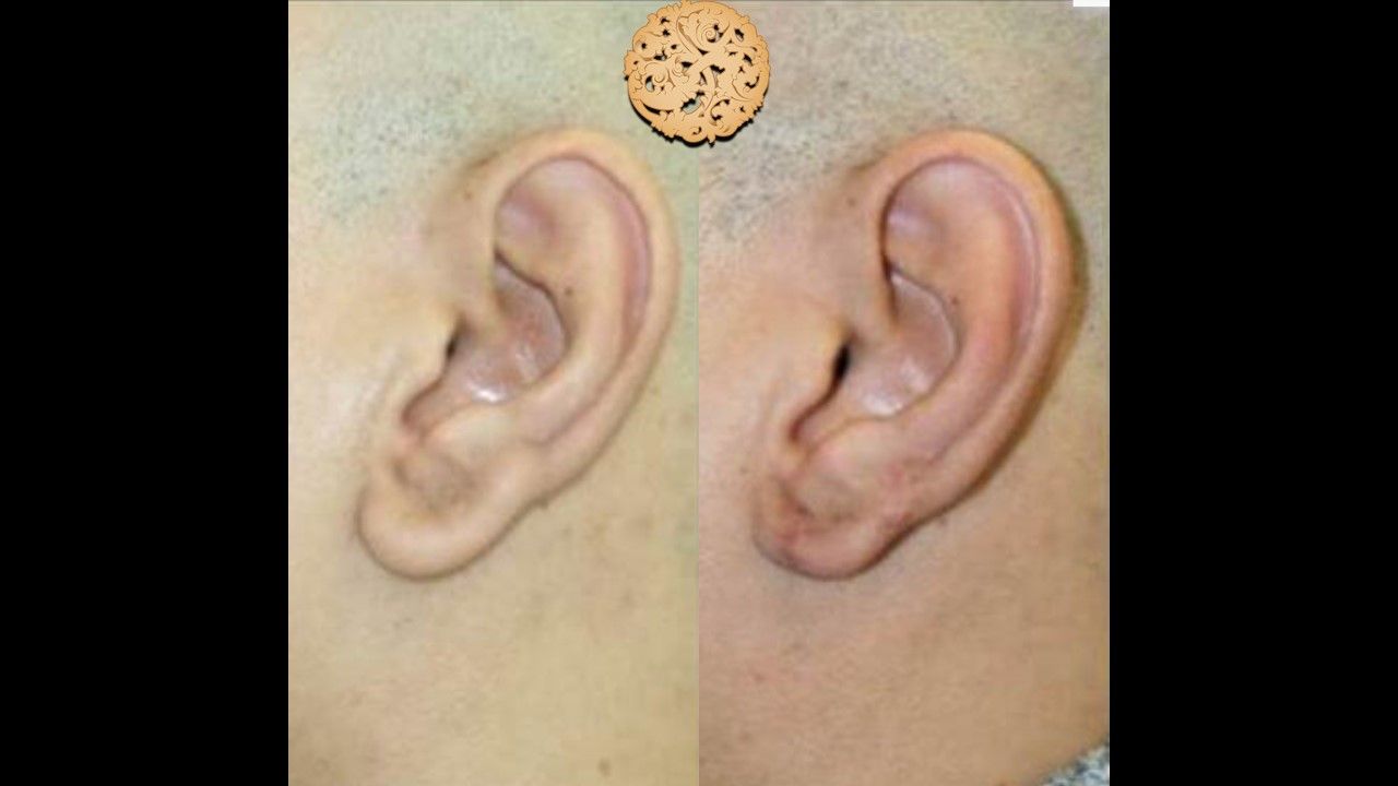 Earlobe Reduction Repair Before & After