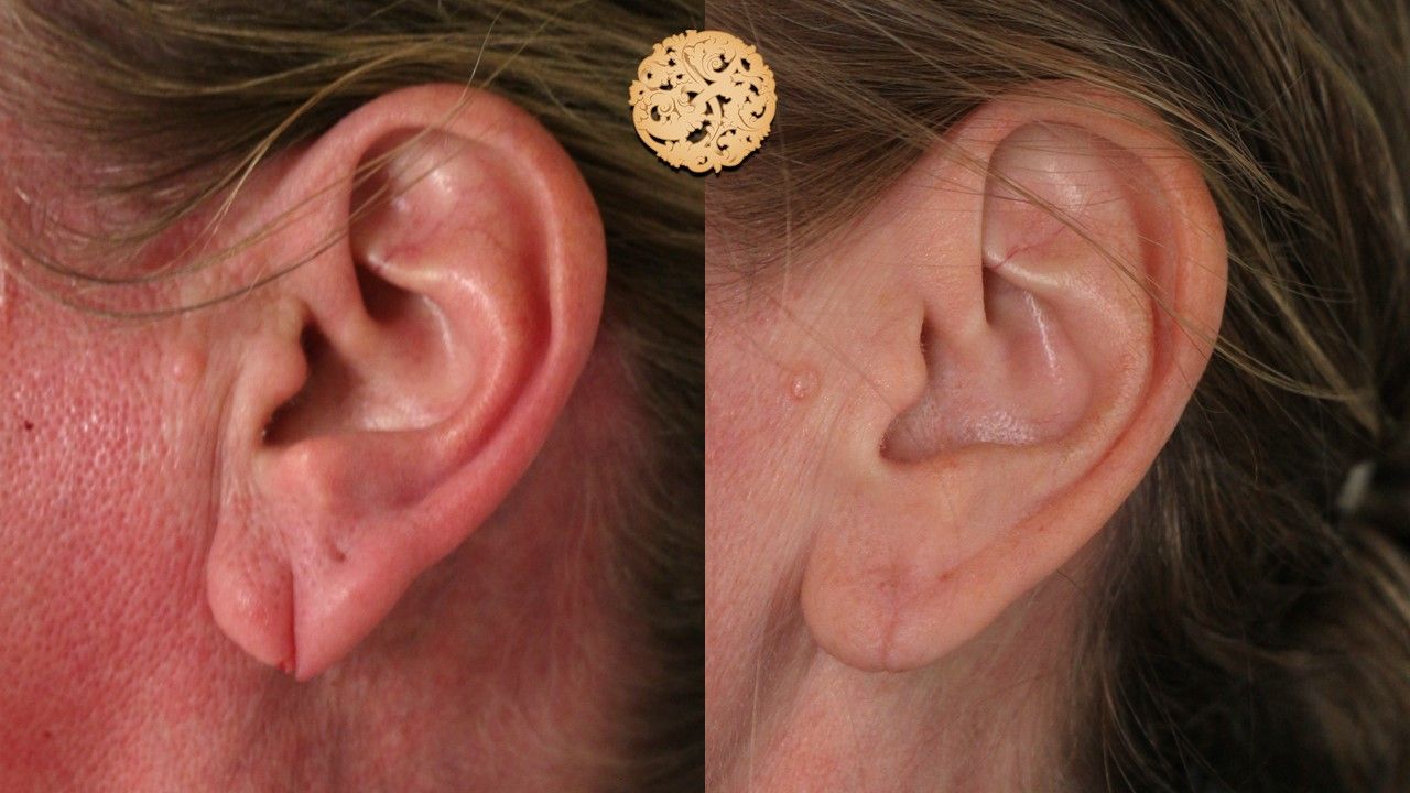 Earlobe Reduction Repair Before & After