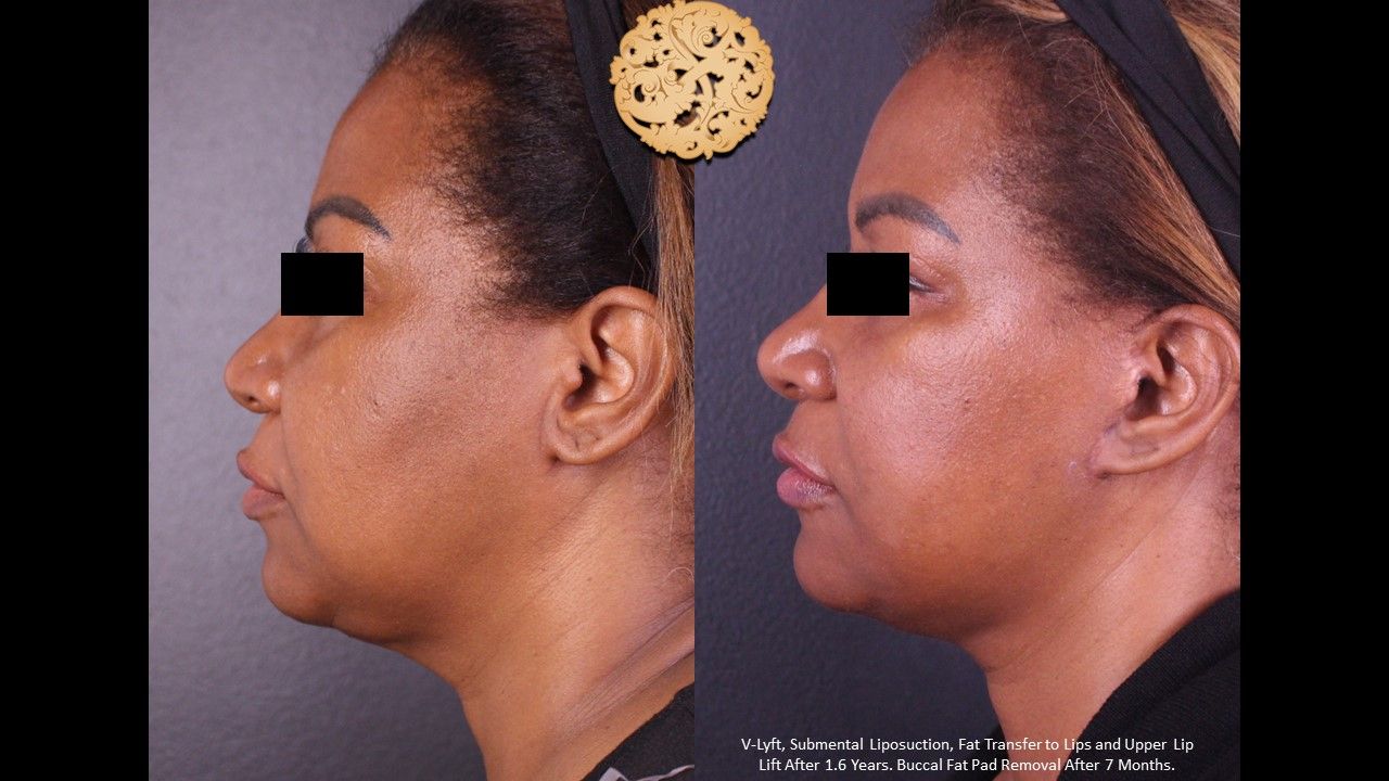 Facelift Neck Lift Before & After