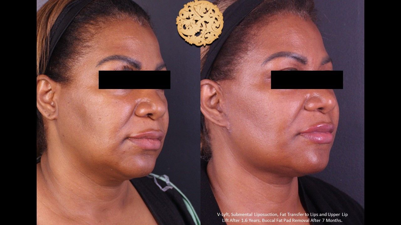Facelift Neck Lift Before & After