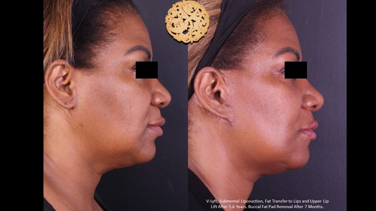 Facelift Neck Lift Before & After