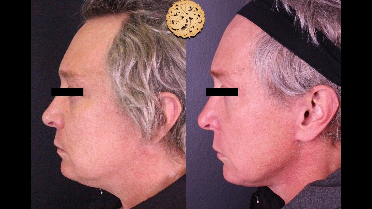 Facelift Neck Lift Before & After