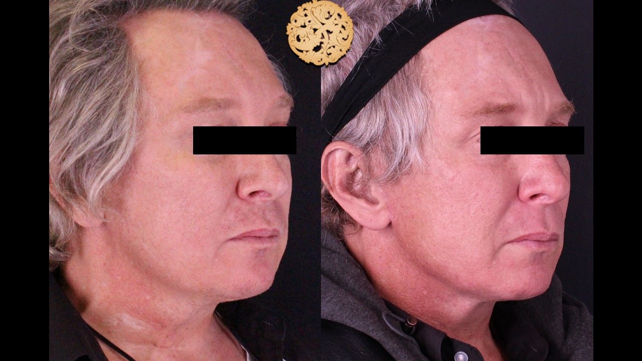 Facelift Neck Lift Before & After
