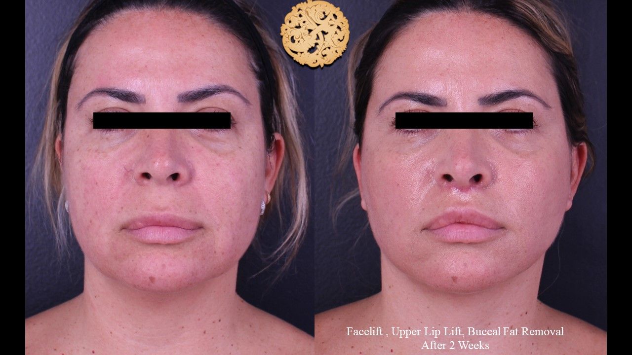 Facelift Neck Lift Before & After