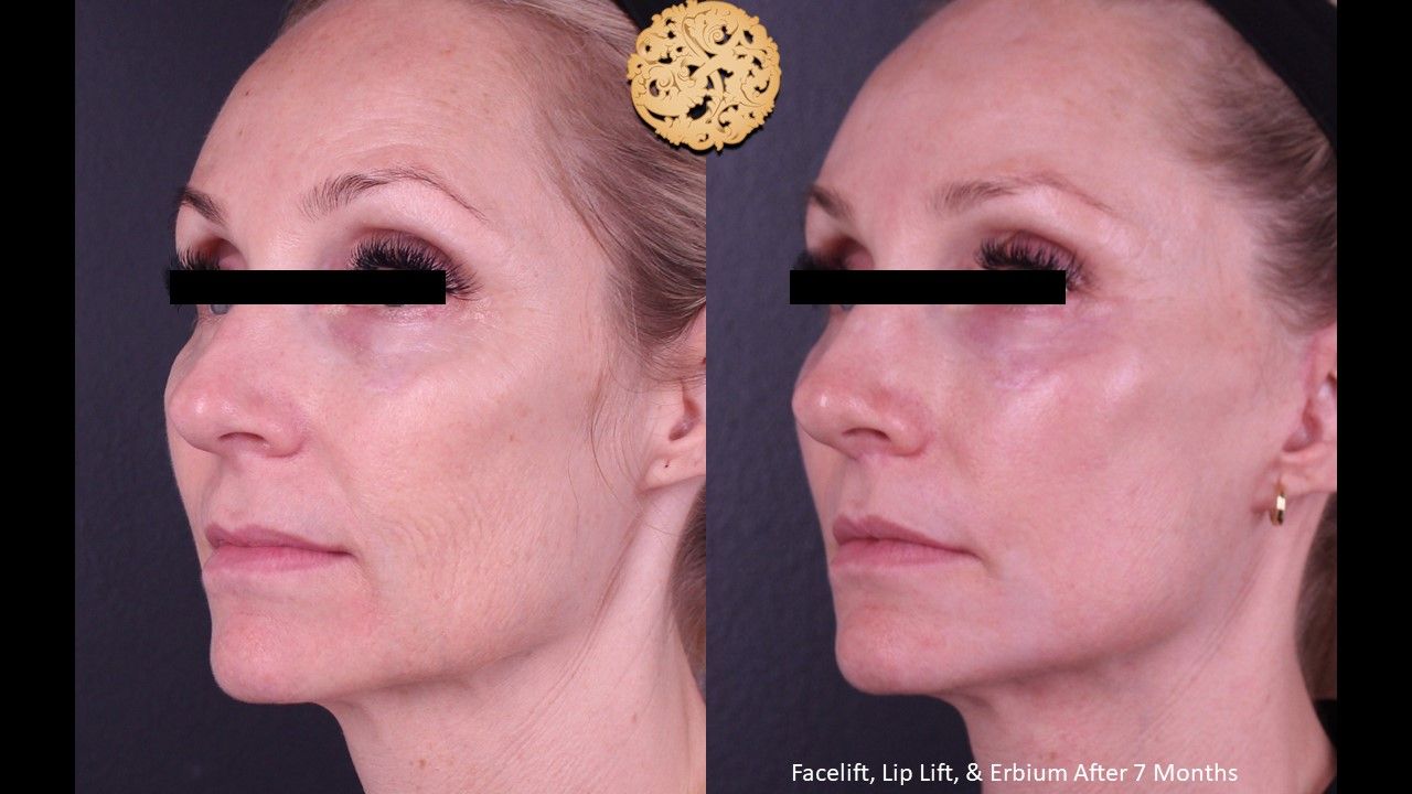 Facelift Neck Lift Before & After