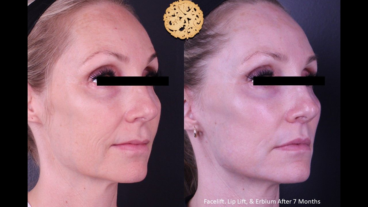 Facelift Neck Lift Before & After