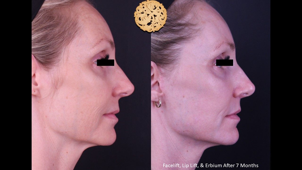 Facelift Neck Lift Before & After