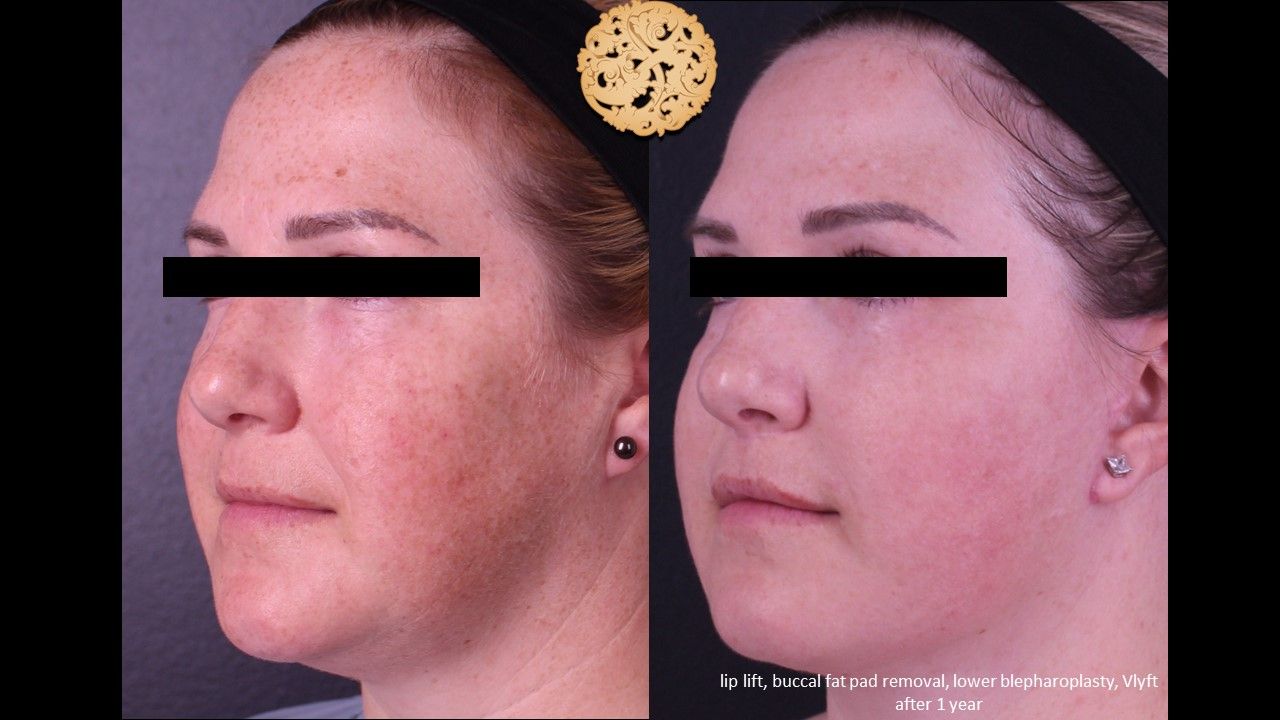 Facelift Neck Lift Before & After