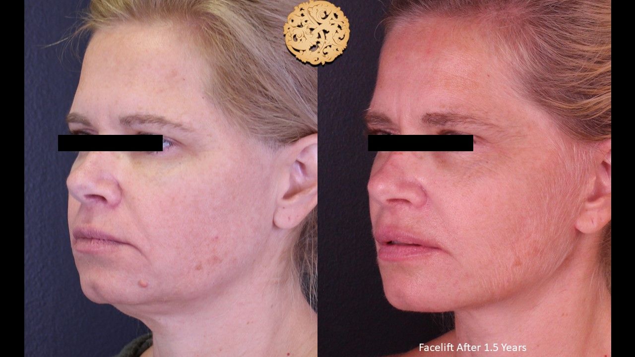 Facelift Neck Lift Before & After