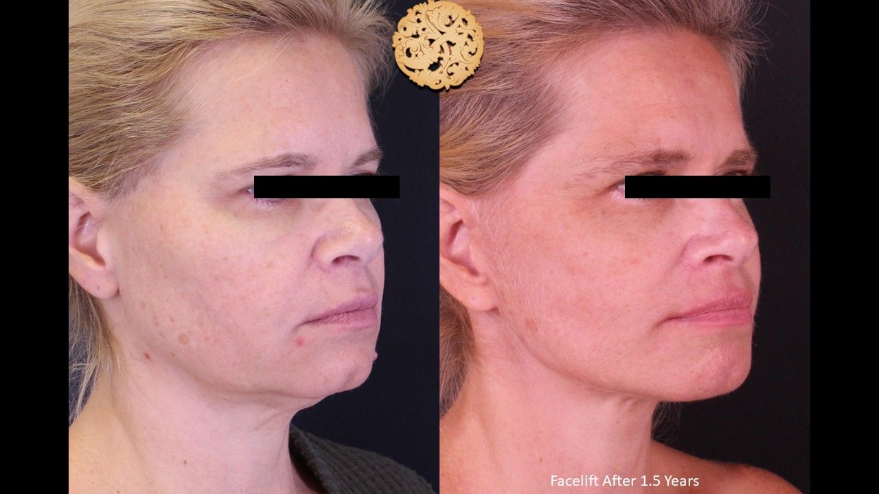 Facelift Neck Lift Before & After