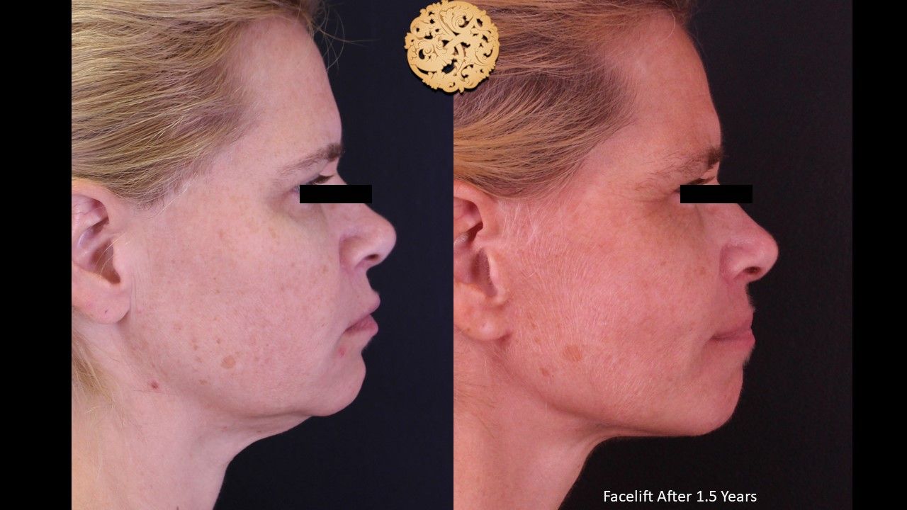 Facelift Neck Lift Before & After