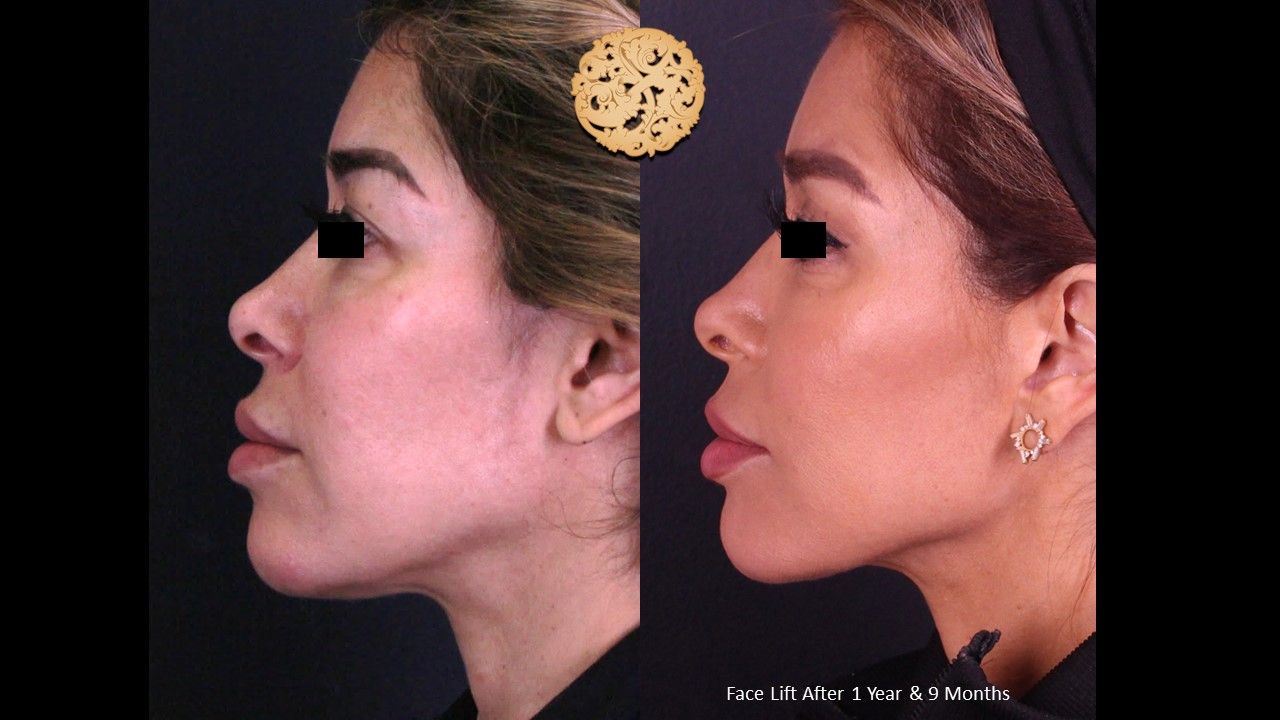 Facelift Neck Lift Before & After