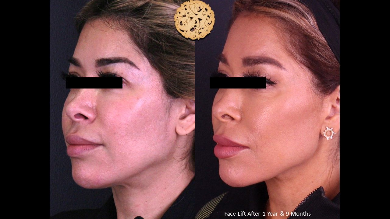Facelift Neck Lift Before & After