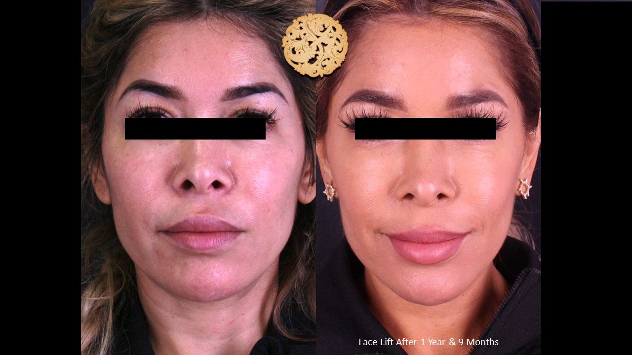 Facelift Neck Lift Before & After