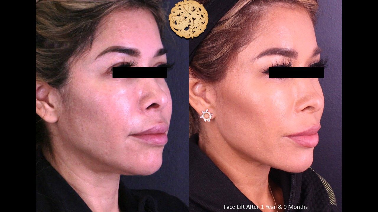 Facelift Neck Lift Before & After
