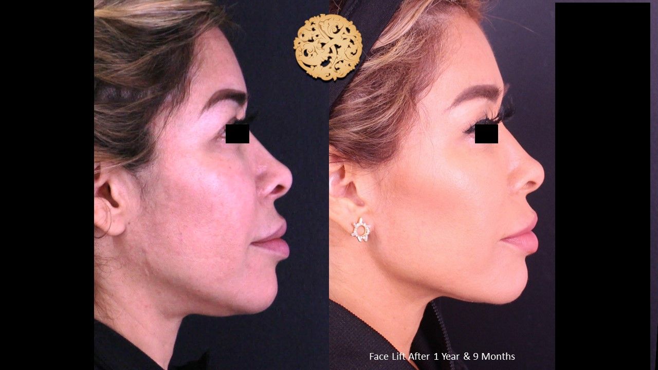 Facelift Neck Lift Before & After