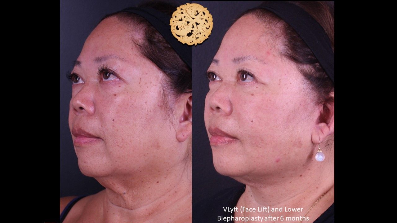 Facelift Neck Lift Before & After