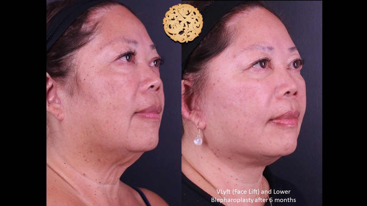 Facelift Neck Lift Before & After