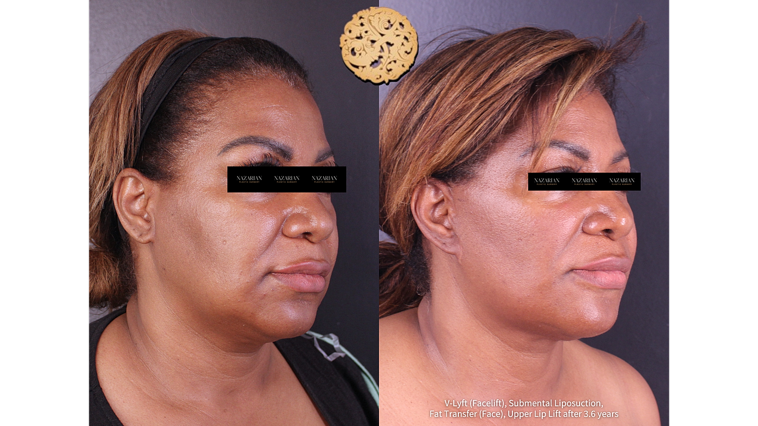Before and after facial cosmetic procedures comparison.