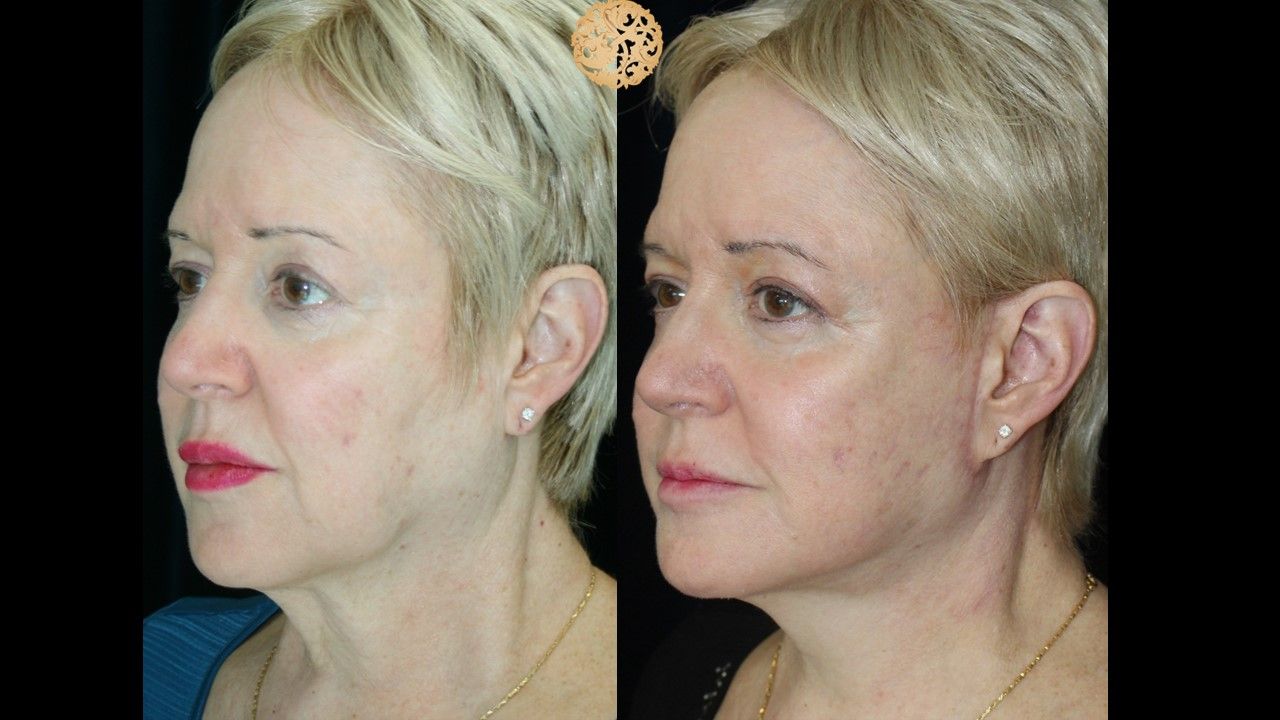 Facelift Neck Lift Before & After