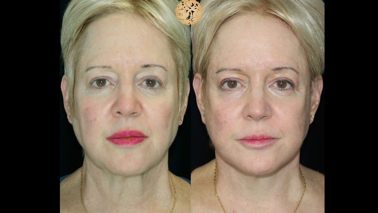 Facelift Neck Lift Before & After
