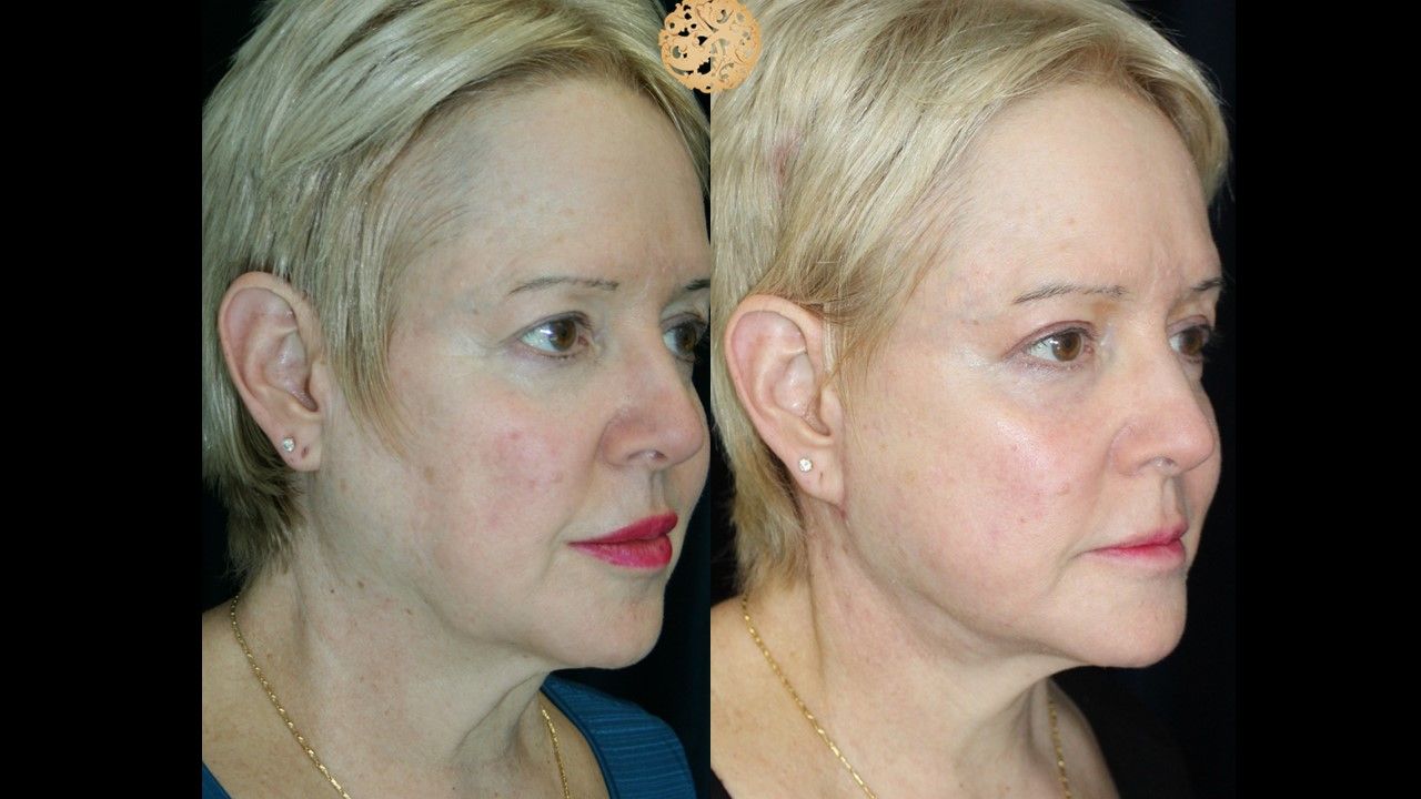 Facelift Neck Lift Before & After