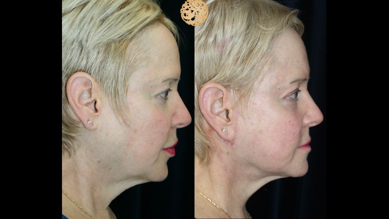 Facelift Neck Lift Before & After