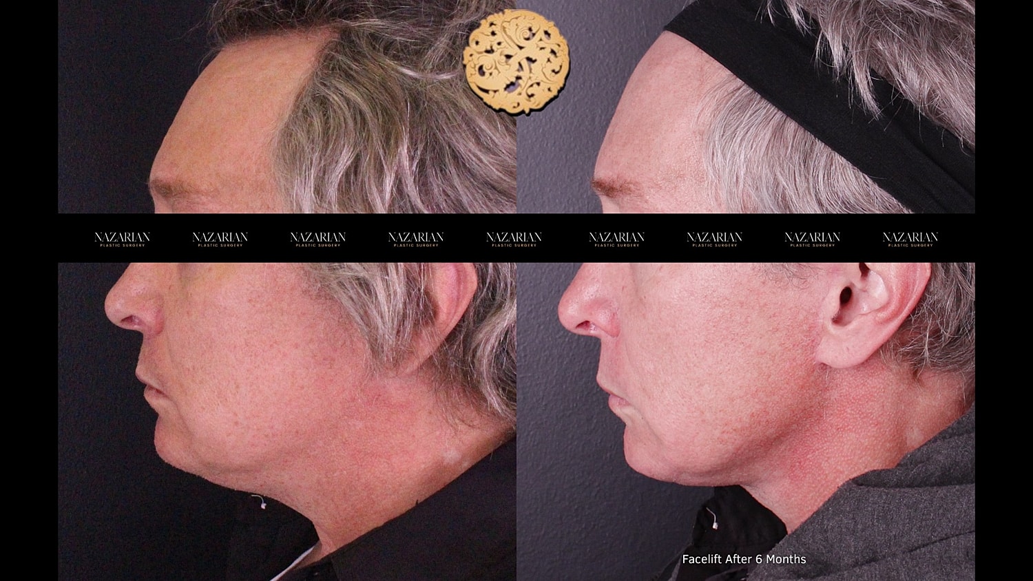 Facelift results, six months post-surgery.