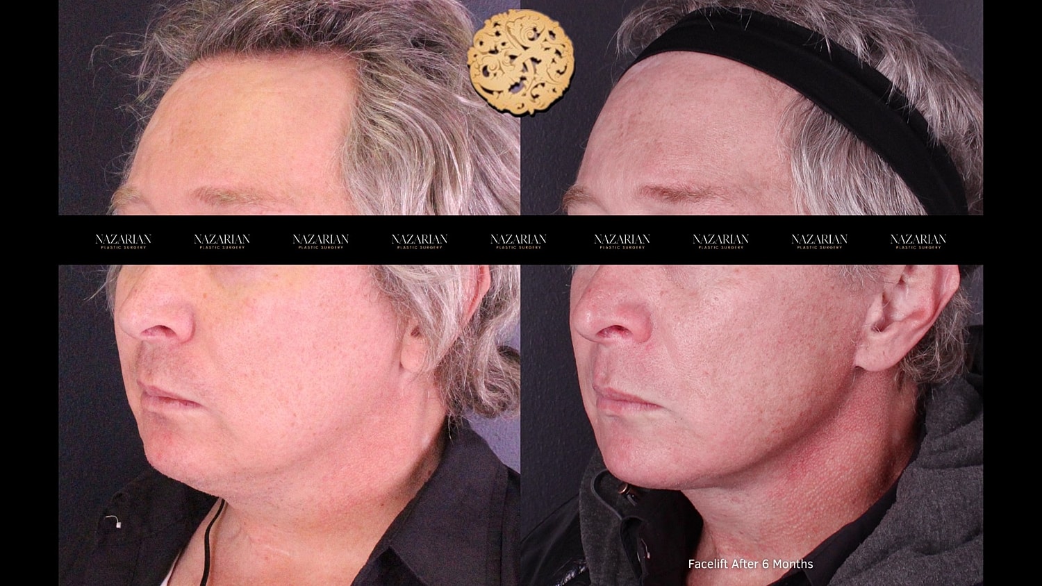 Before and after facelift comparison, six months later.