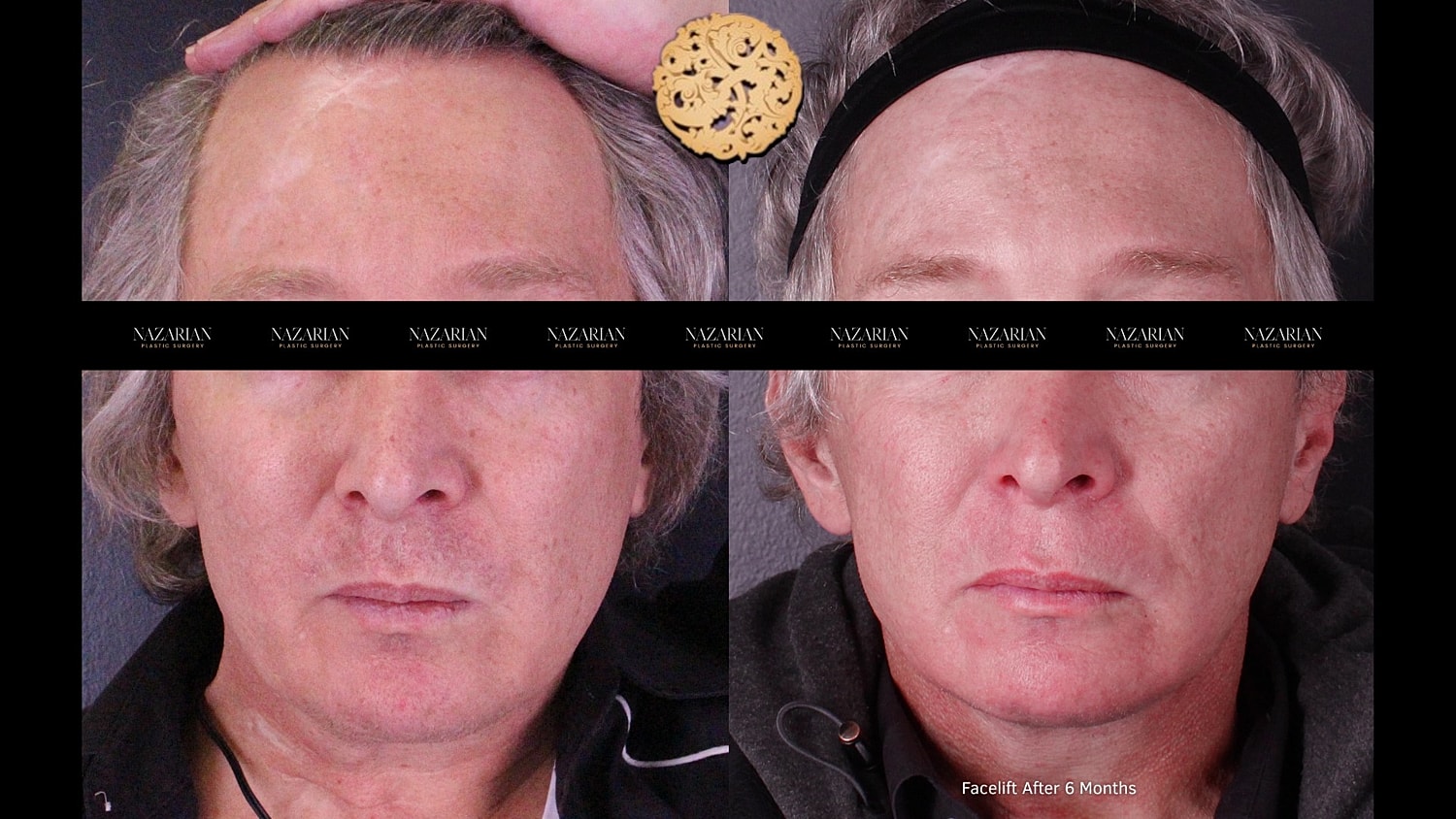 Facelift results before and after 6 months.