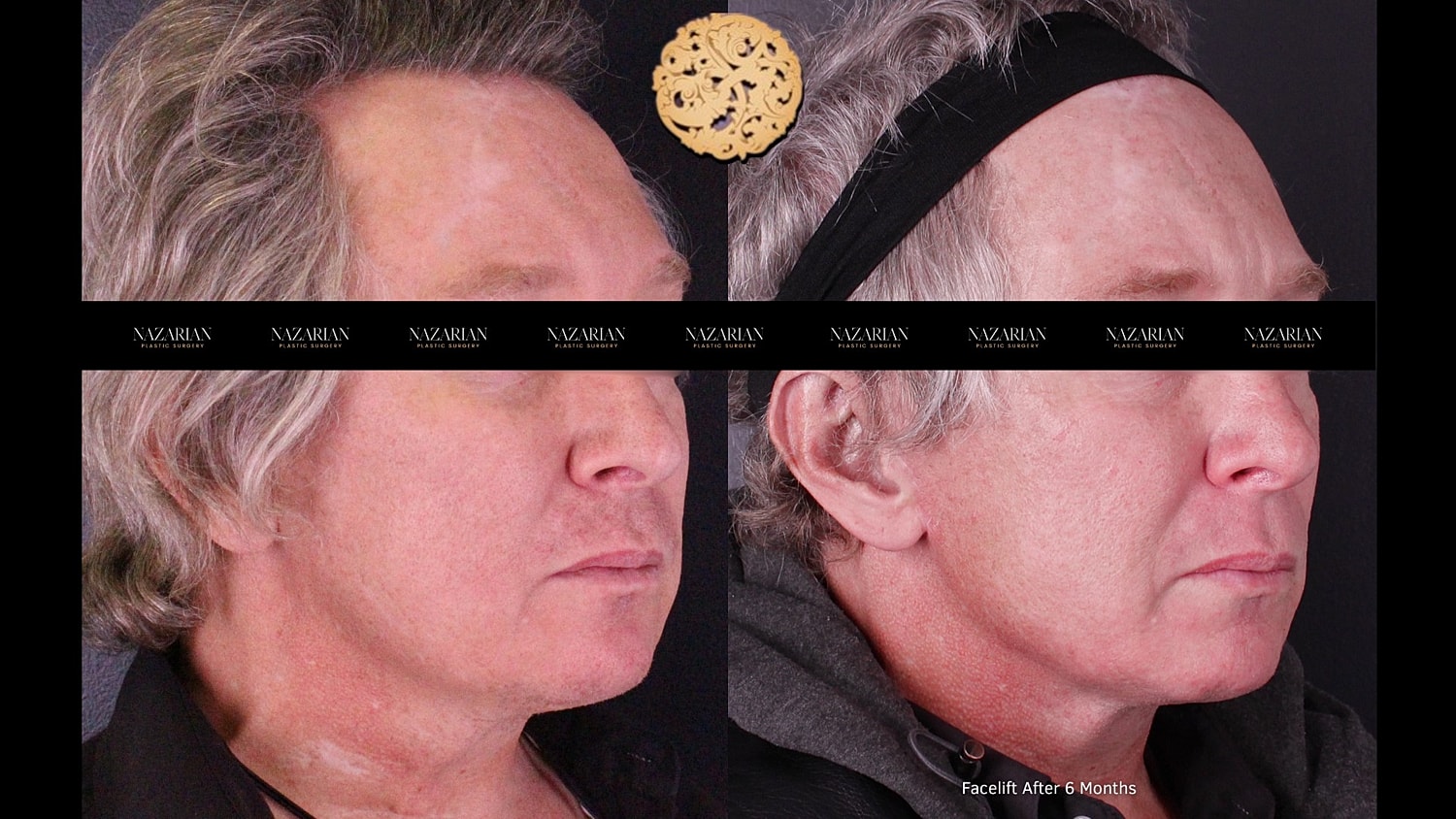 Before and after facelift comparison photo.