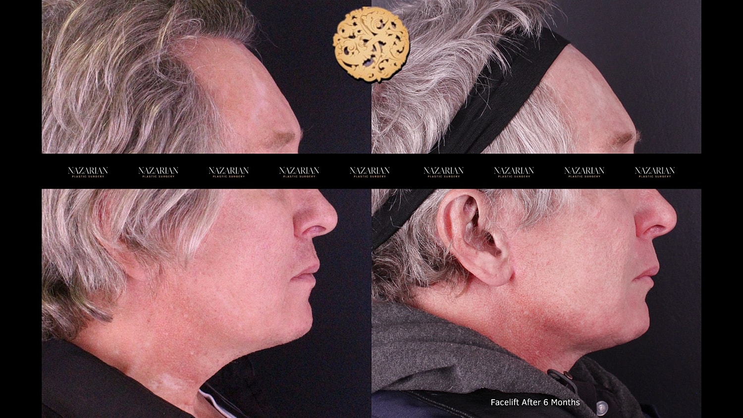 Facelift results shown from two profile angles.