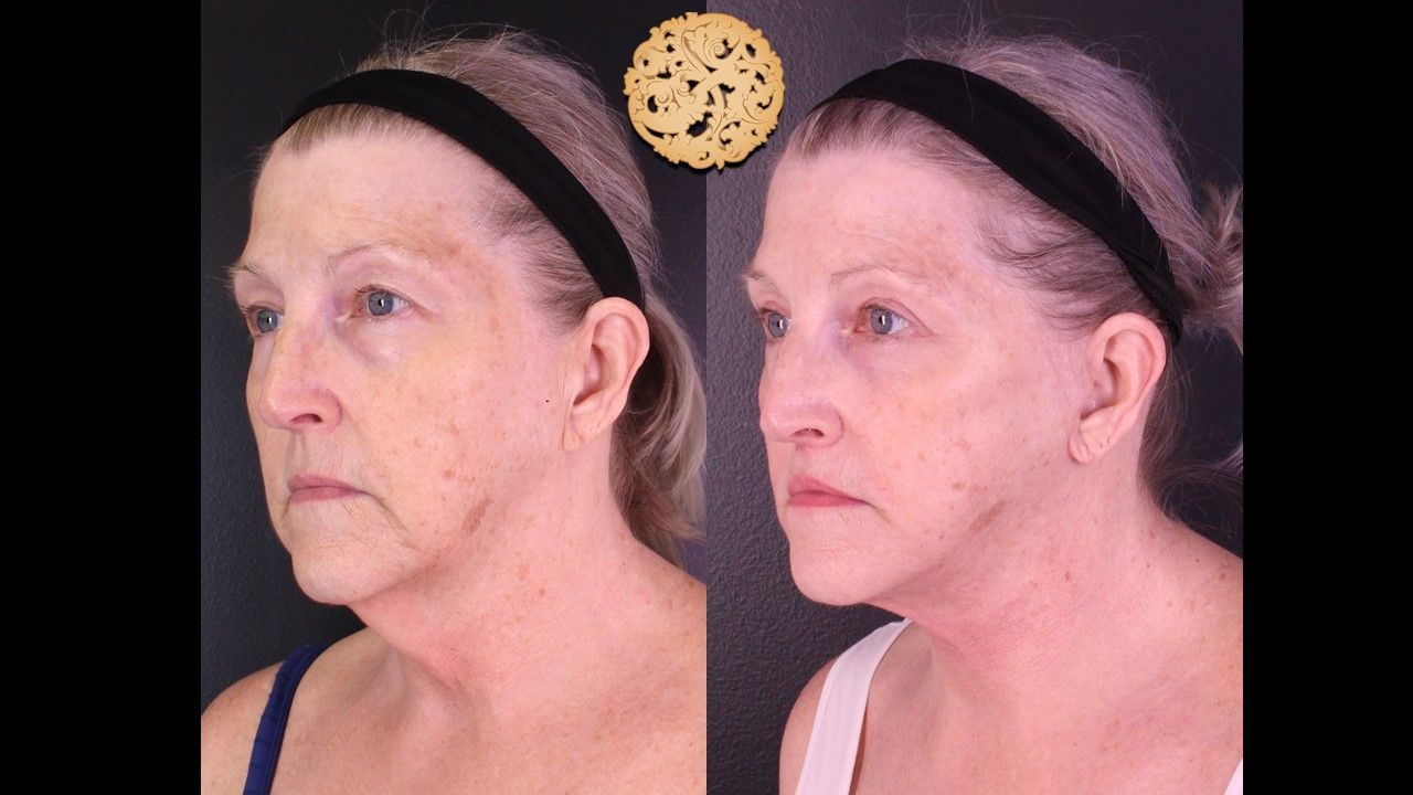 Facelift Neck Lift Before & After