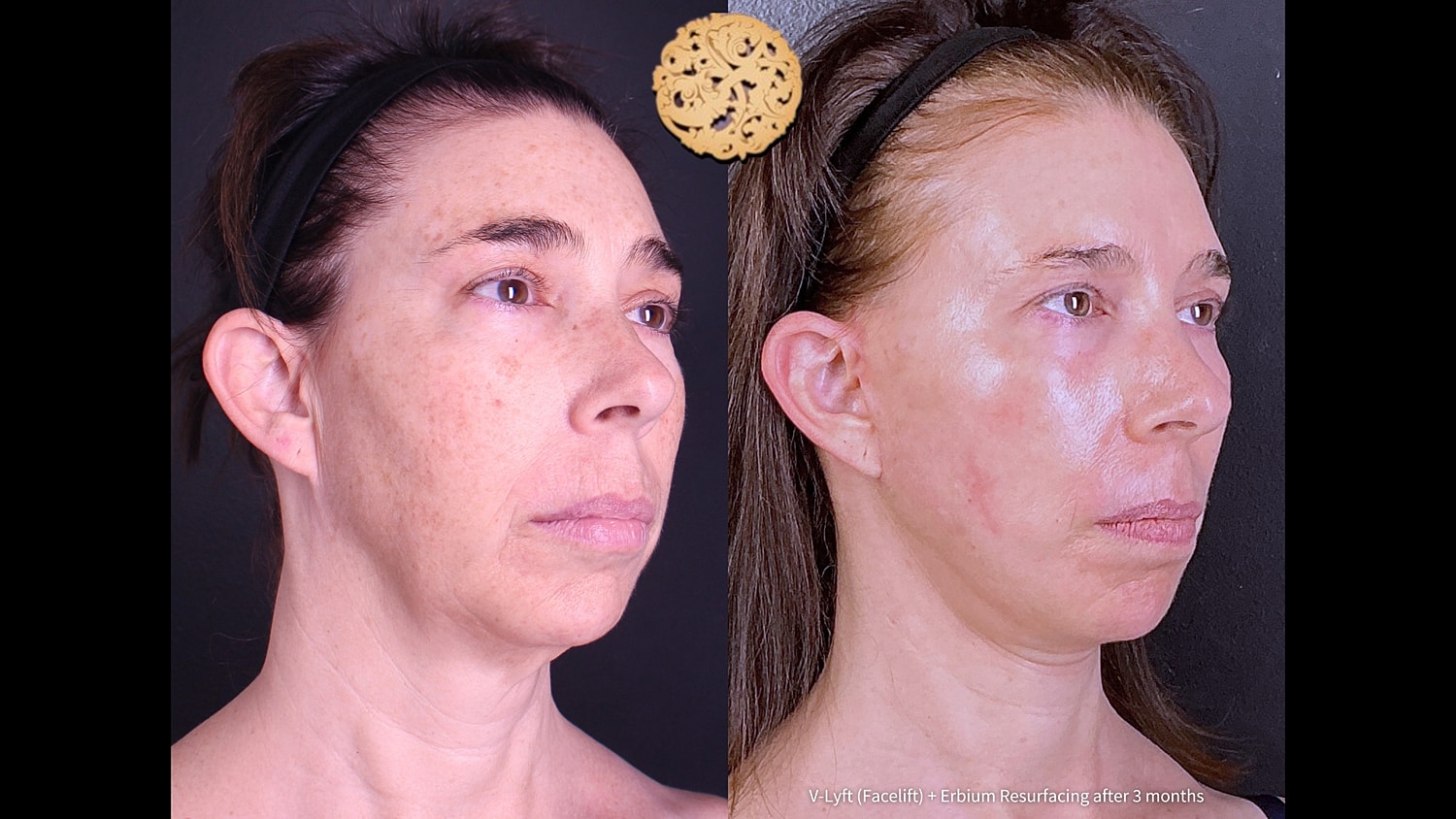 Before and after facial rejuvenation treatment comparison.