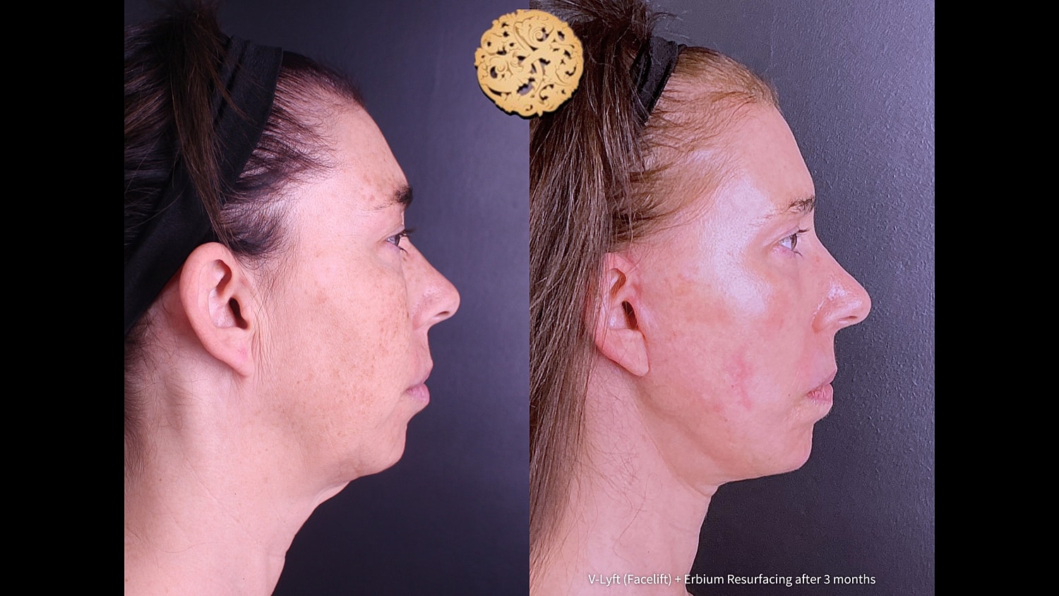 Before and after facial treatment comparison.