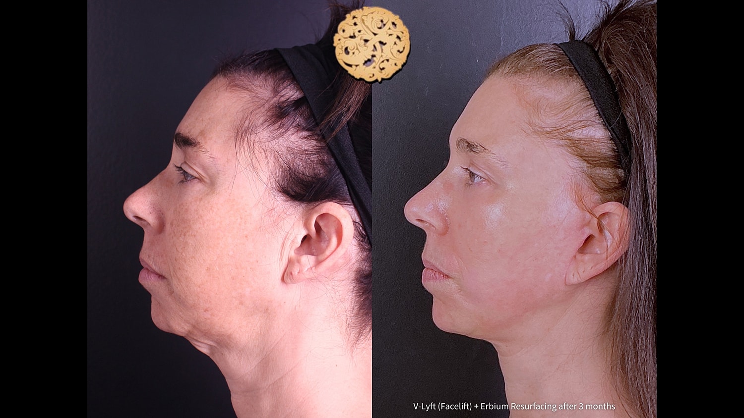 Before and after facial rejuvenation treatment comparison.