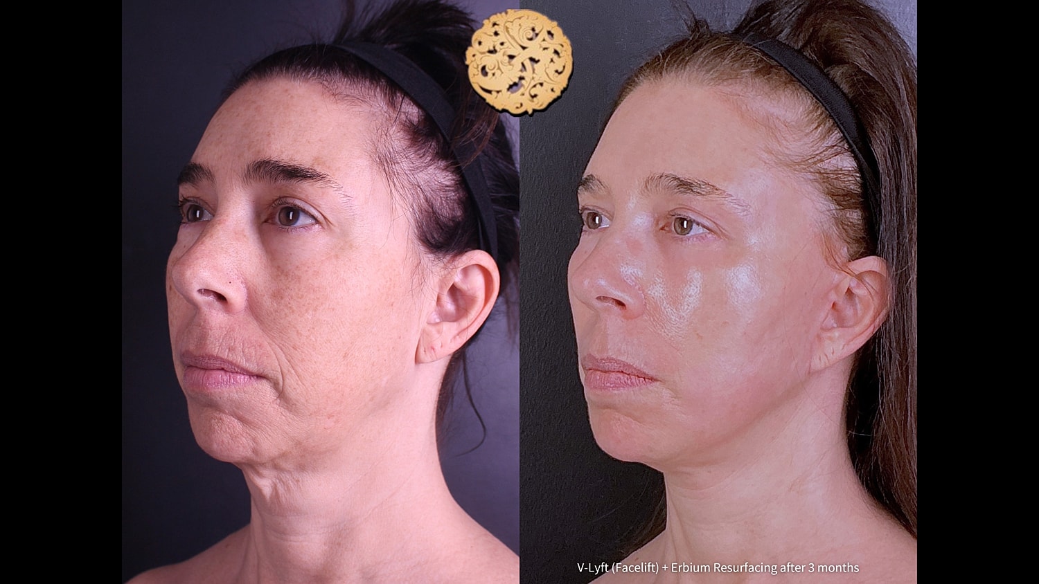 Before and after skin treatment comparison photo.