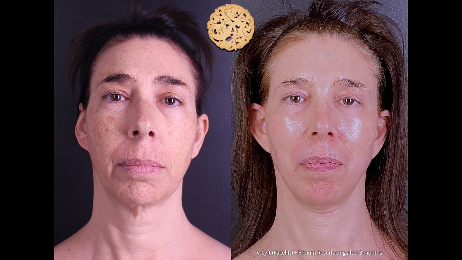 Before and after facial rejuvenation treatment results.