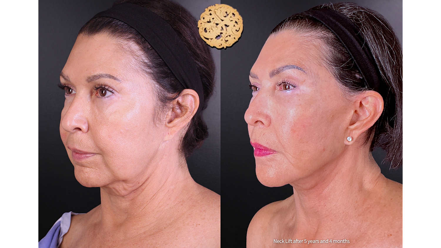 Facelift Neck Lift Before & After