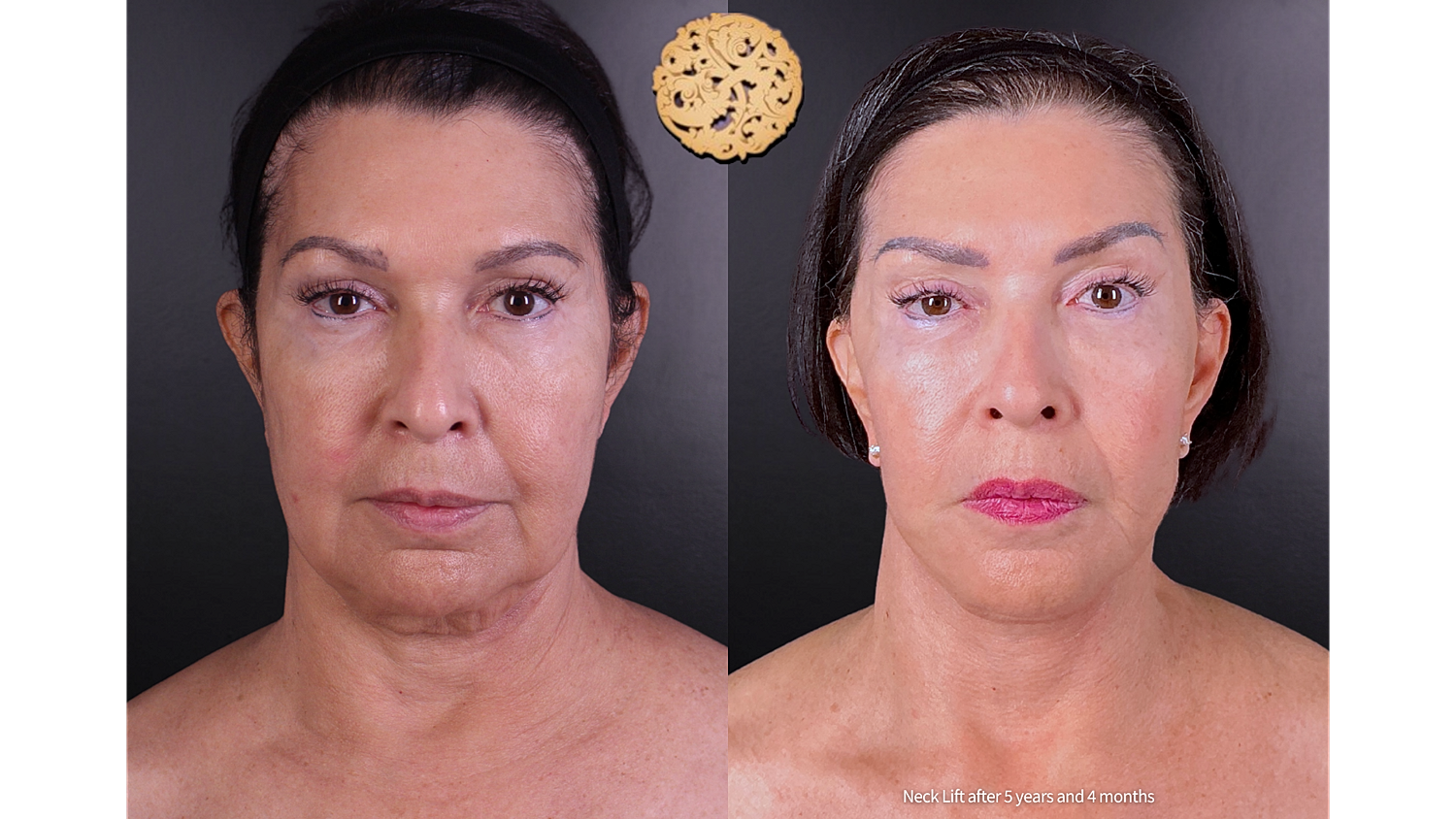Facelift Neck Lift Before & After