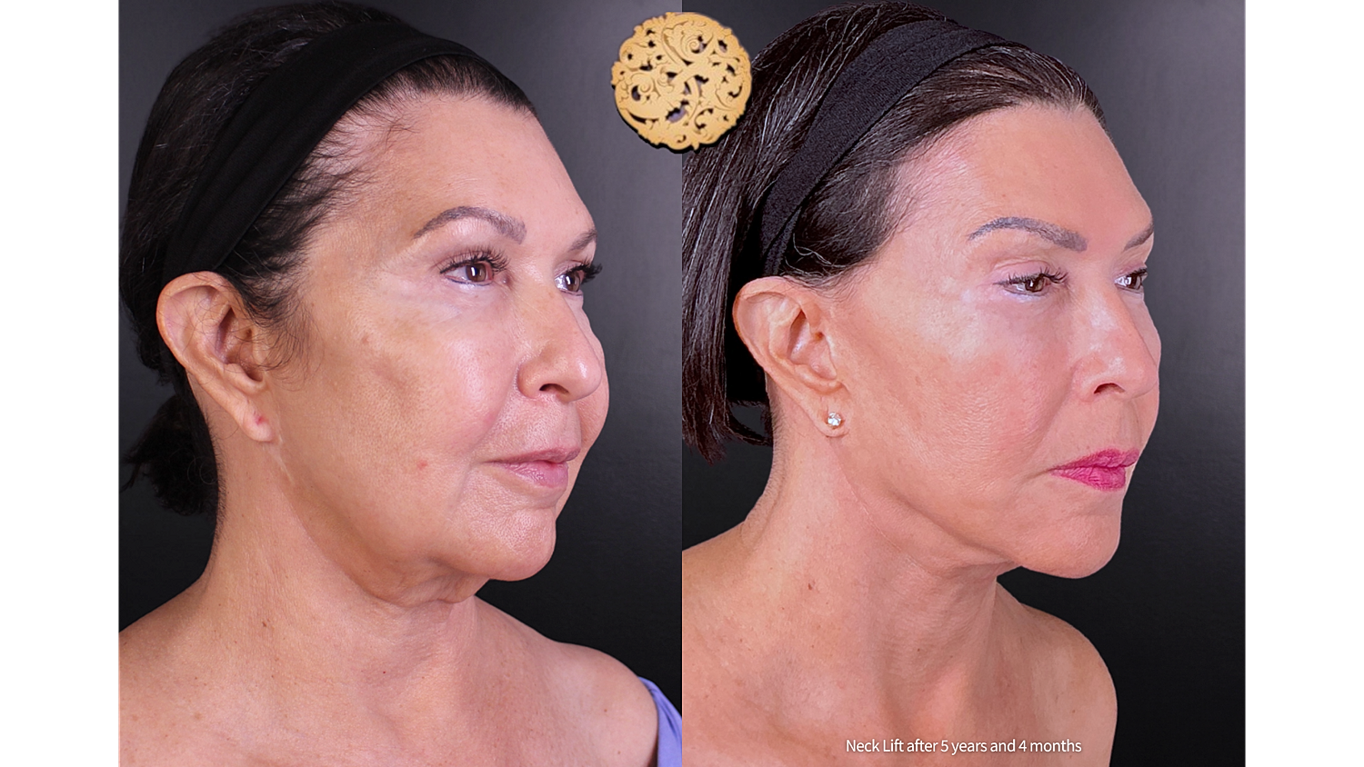 Facelift Neck Lift Before & After