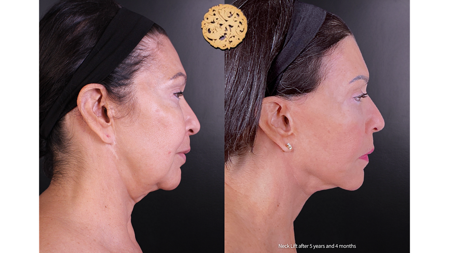 Facelift Neck Lift Before & After