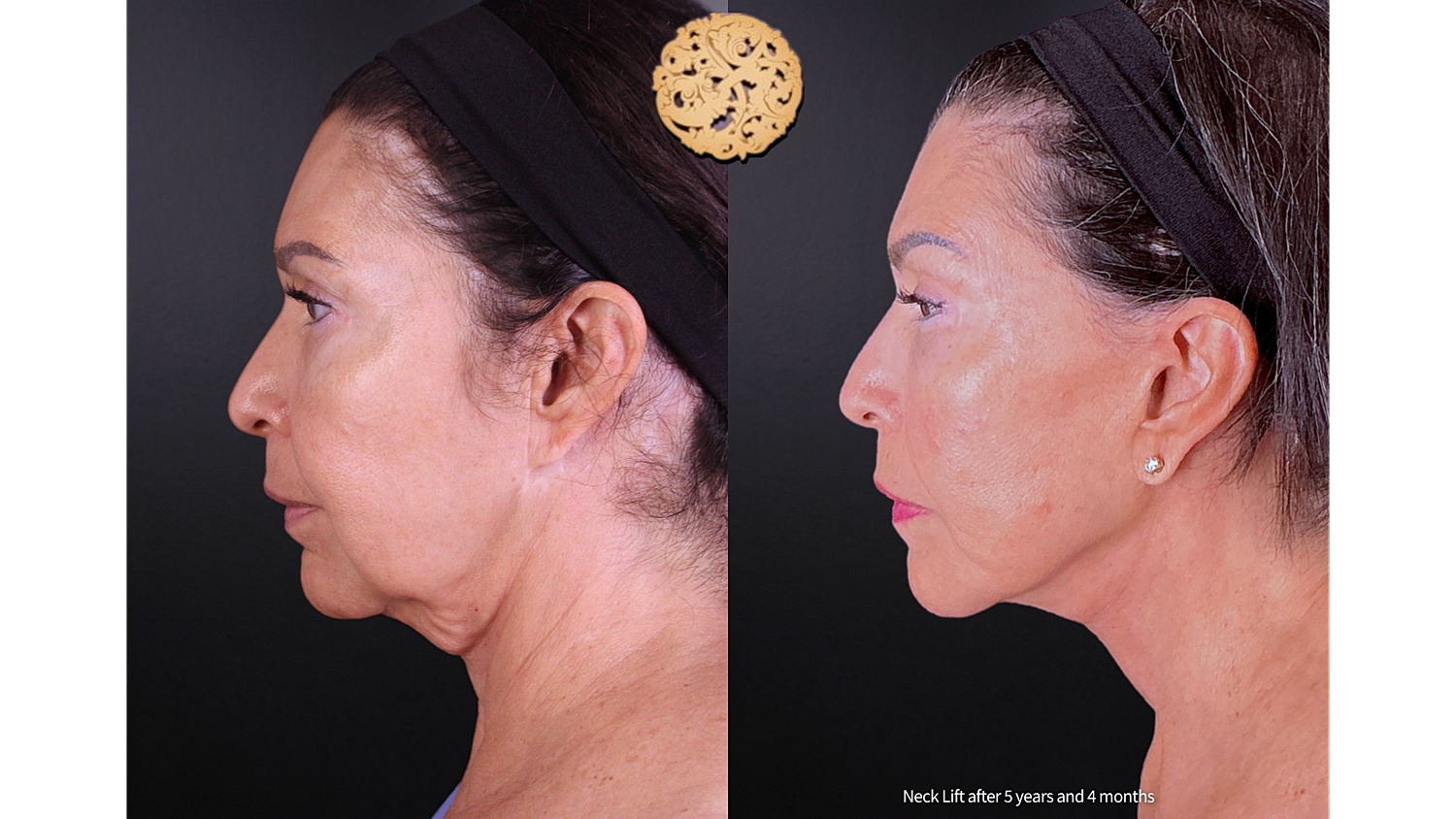 Facelift Neck Lift Before & After