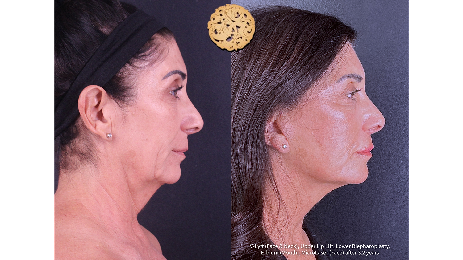 V-Lyft (Face & Neck), Upper Lip Lift, Lower Blepharoplasty, Erbium (Mouth), MicroLaser (Face) after 3.2 years