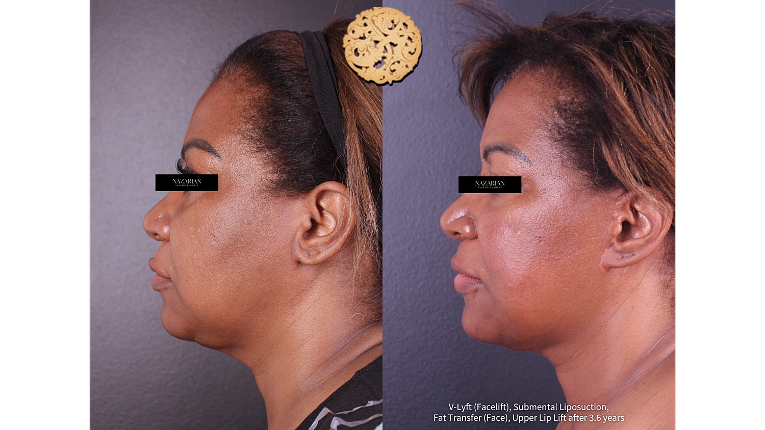 Before and after facial cosmetic procedures comparison.