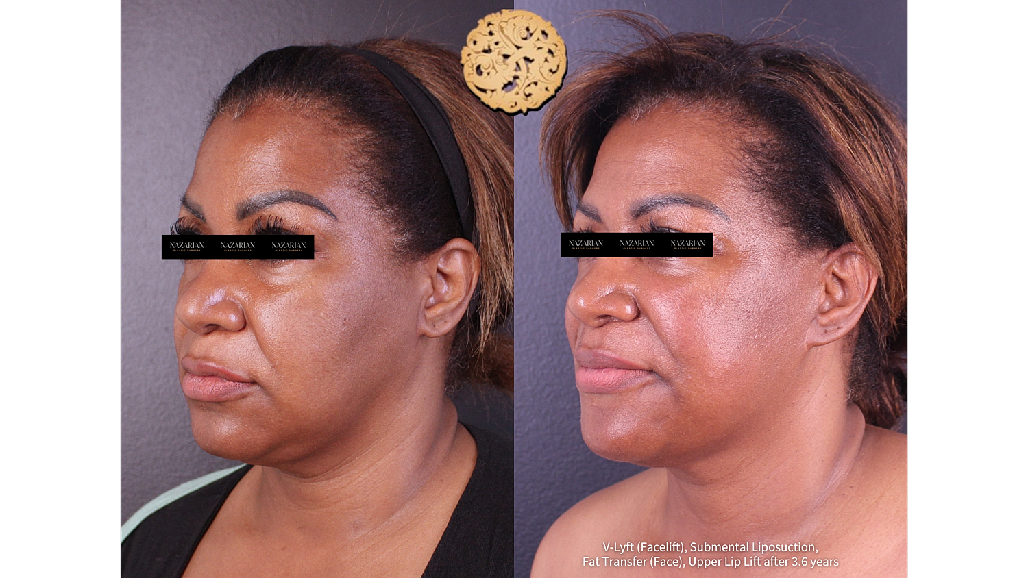 Before and after facial cosmetic procedures comparison.
