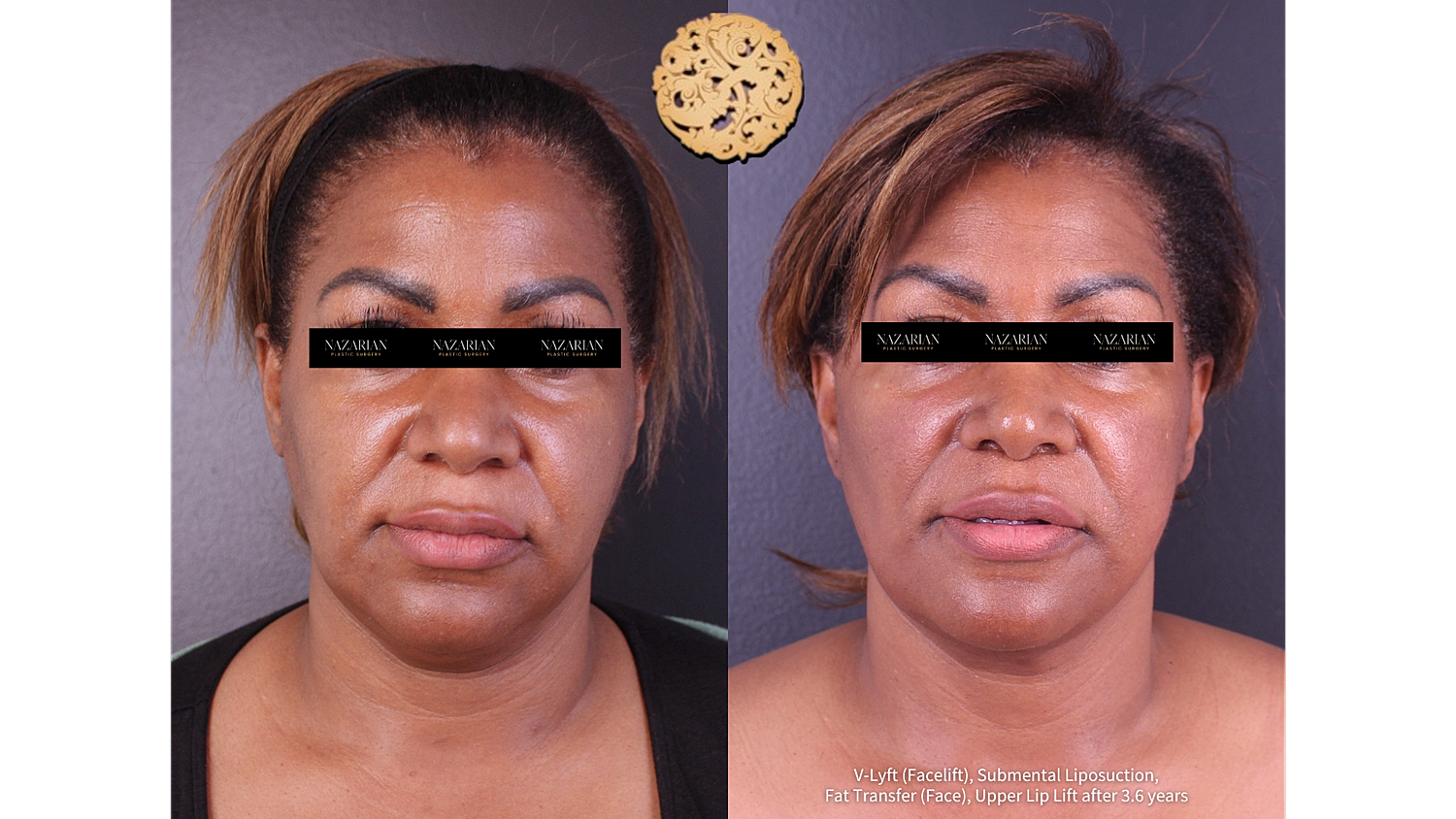 Before and after facial cosmetic procedures comparison.